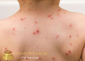 Bệnh thủy đậu tắm lá gì?